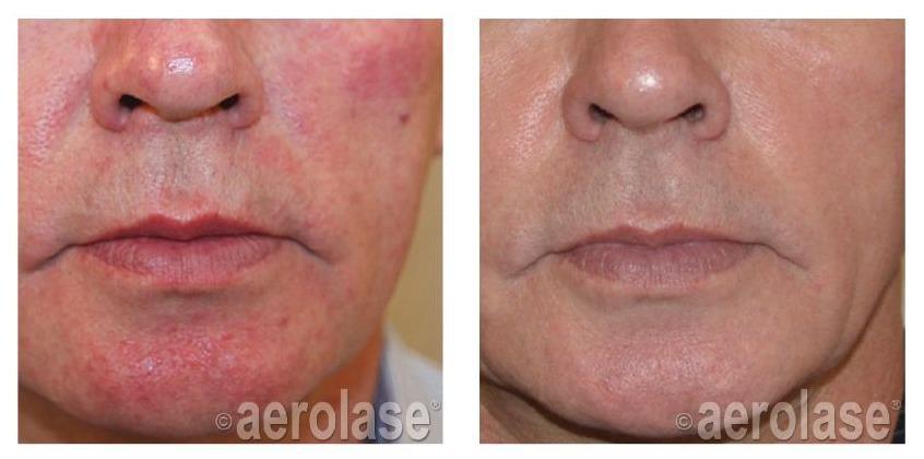 After 2 Treatments