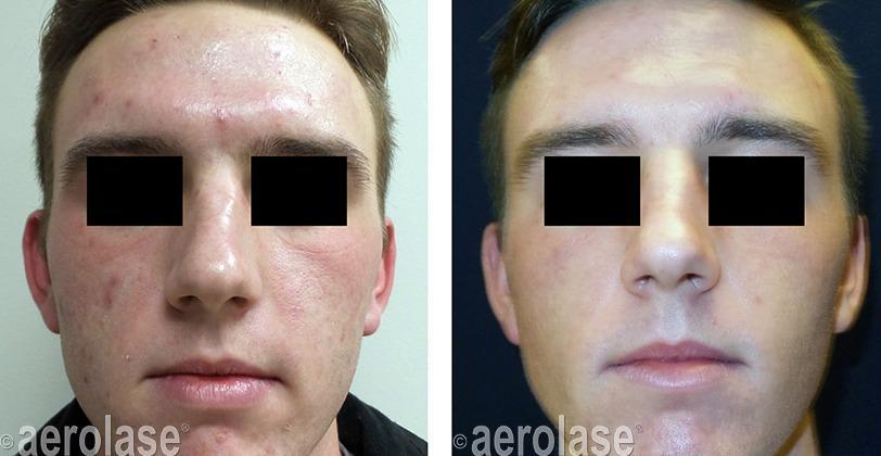 After 3 Treatments