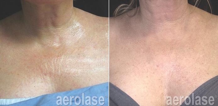 After 4 Treatments