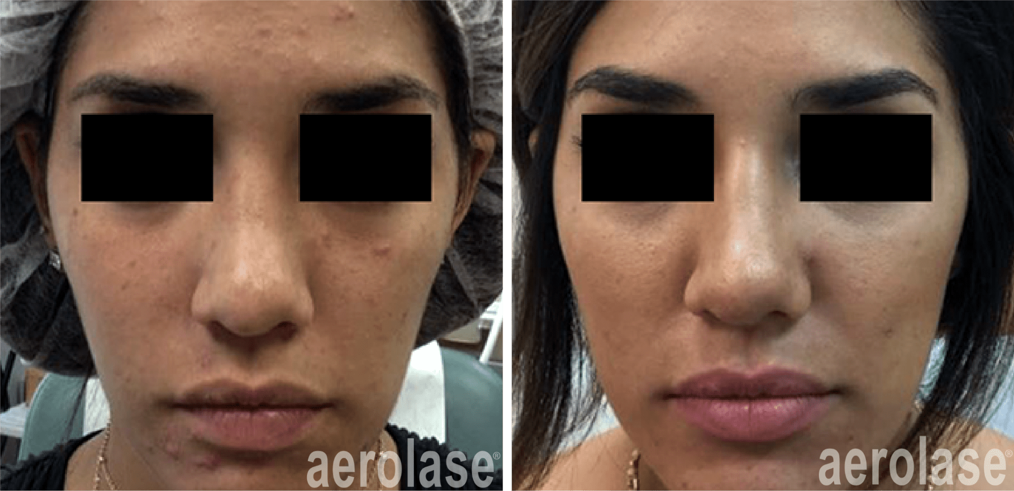 After 4 Treatments
